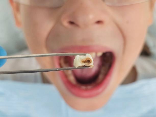 Best Dentist for Tooth Abscess  in Underwood, IA